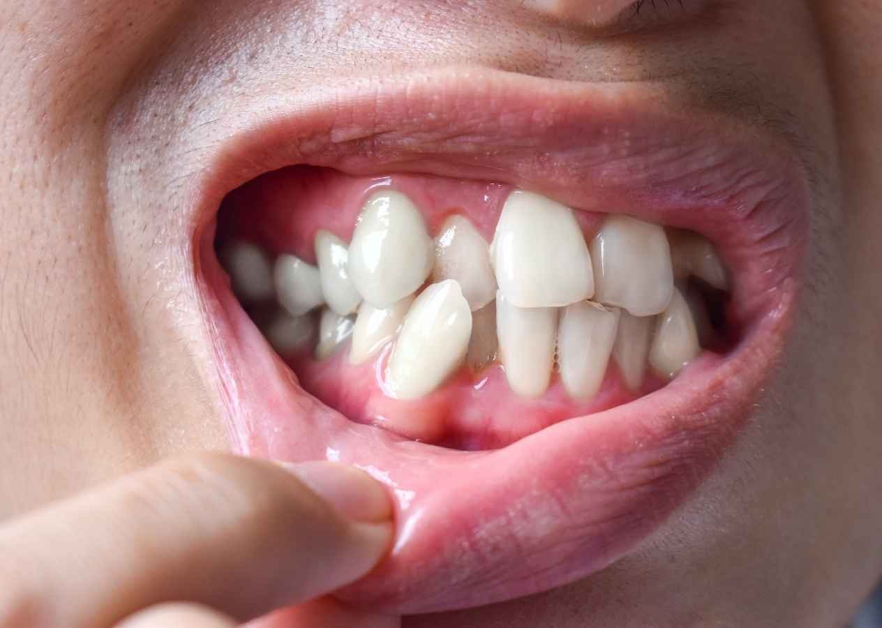 Crowded Teeth