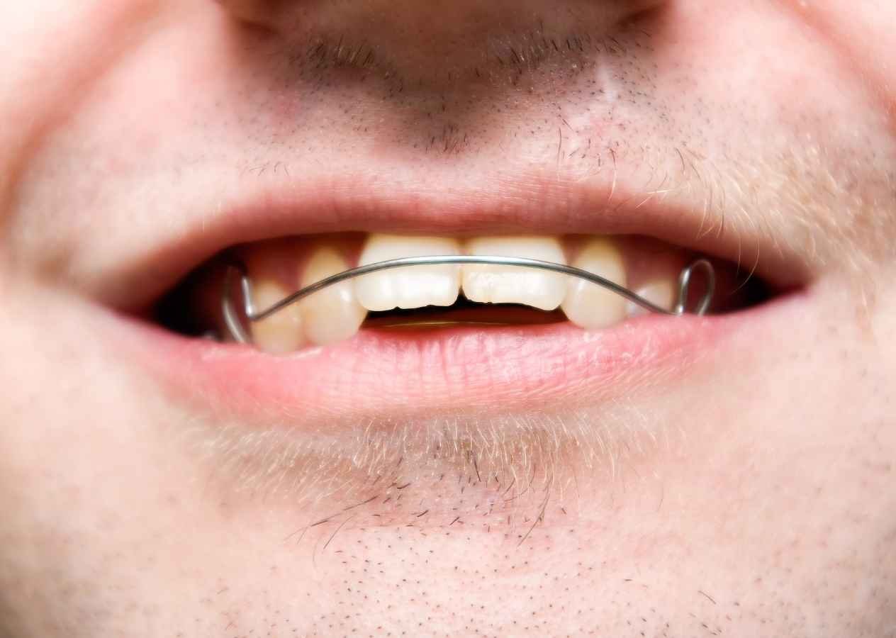 Overbite / Forwardly Placed Teeth