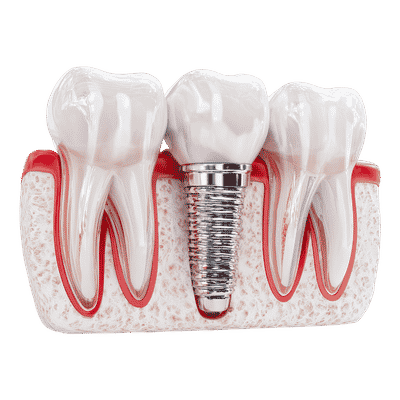 Why Choose Kosmo for Dental Implants