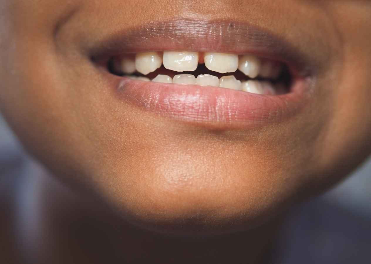 Teeth Gap