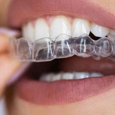 Invisible aligners treatment